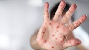 Рост заболеваемости корью и вирусным гепатитом отмечается в Астане