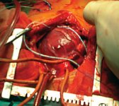 Сердечная достаточность