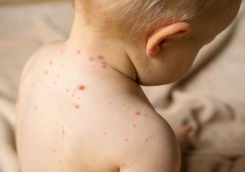 Почти 800 казахстанских детей заболели корью с начала января
