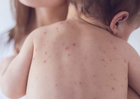 Углубленно изучить причины высокой заболеваемости медиков корью требуют мажилисмены